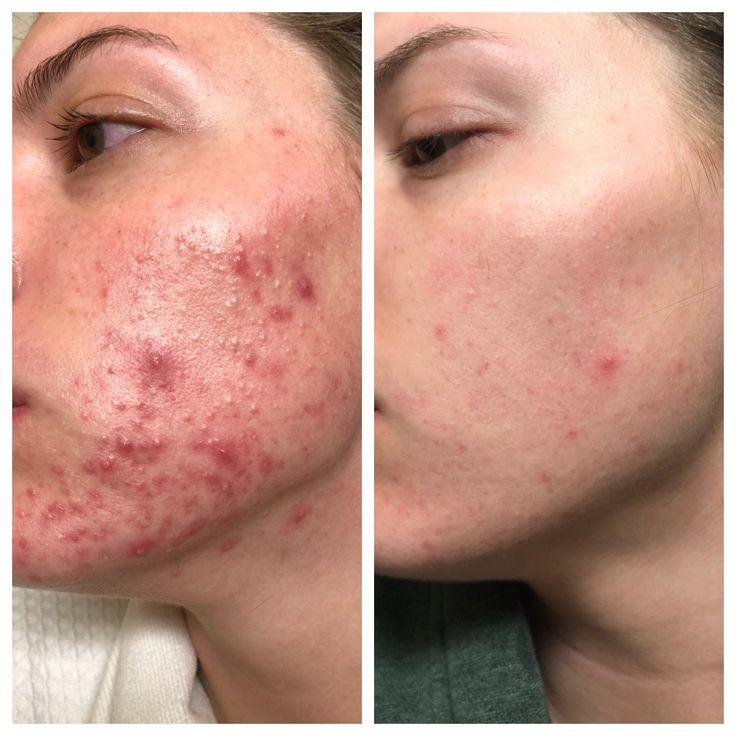 Aobenz Dark Spot Remover