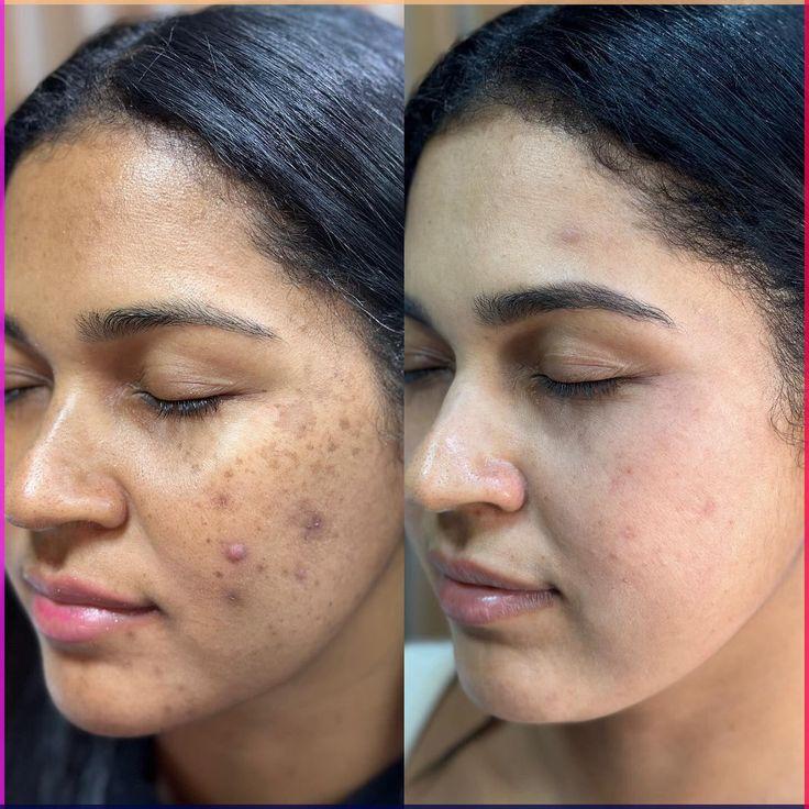 Aobenz Dark Spot Remover